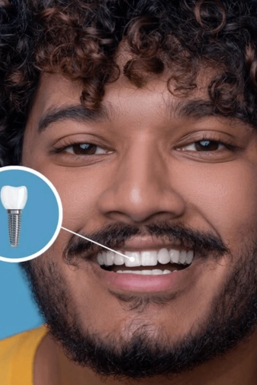 Dental Implants